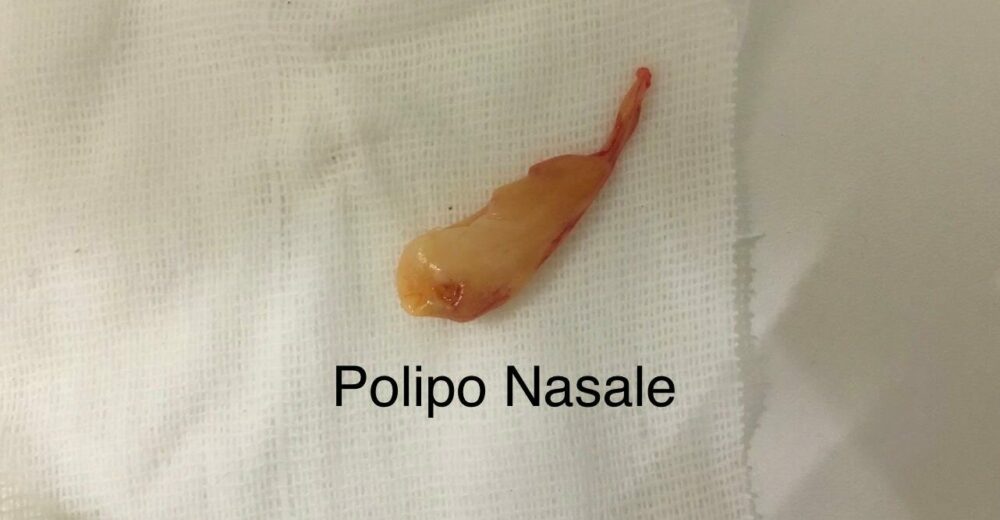 papilloma fossa nasale