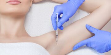 Iperidrosi: «Il botulino può essere la soluzione per la sudorazione eccessiva»