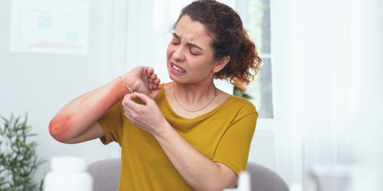 Allergia al nichel: dalla dermatite da contatto alla Snas