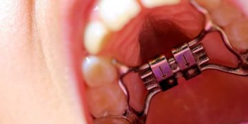 Palato stretto bambino Dott.ssa Cristina Vitale dentista dei bambini a Roma