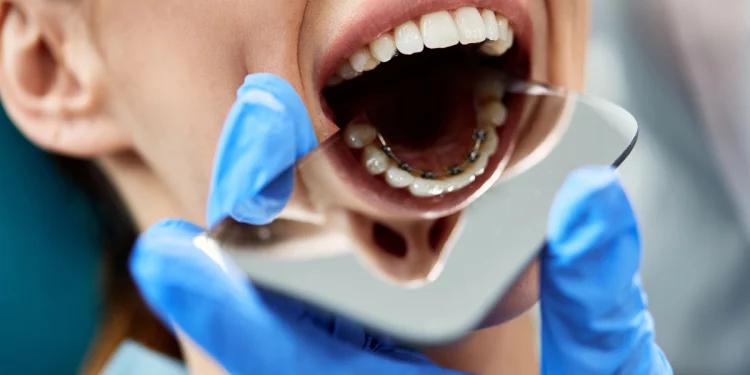 Apparecchio ai denti da adulti? Sì, con l’ortodonzia linguale