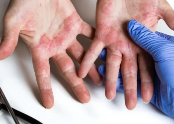 Dermatite atopica alle mani in un bambino, valutazione medica durante visita allergologica
