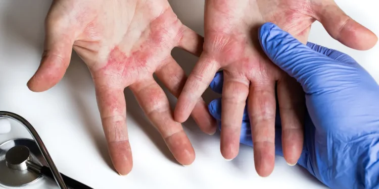 Dermatite atopica alle mani in un bambino, valutazione medica durante visita allergologica