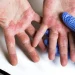 Dermatite atopica alle mani in un bambino, valutazione medica durante visita allergologica